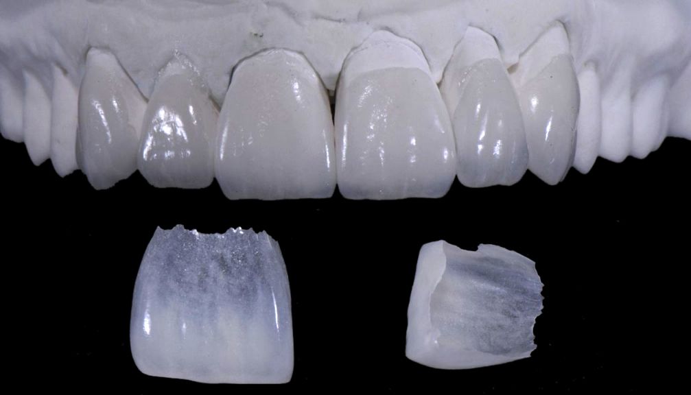 feldspathic porcelain veneers