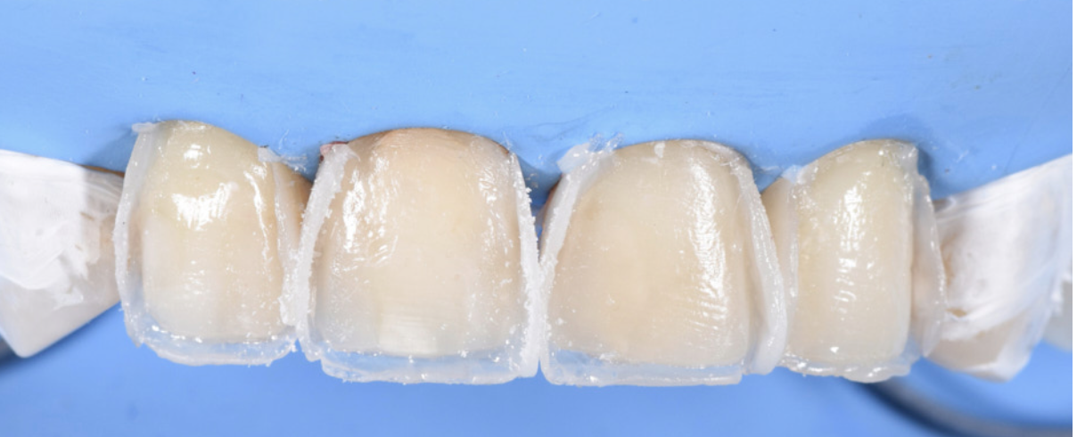 composite veneers