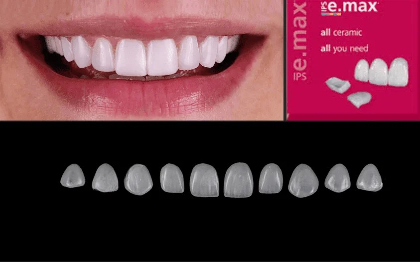 emax veneers