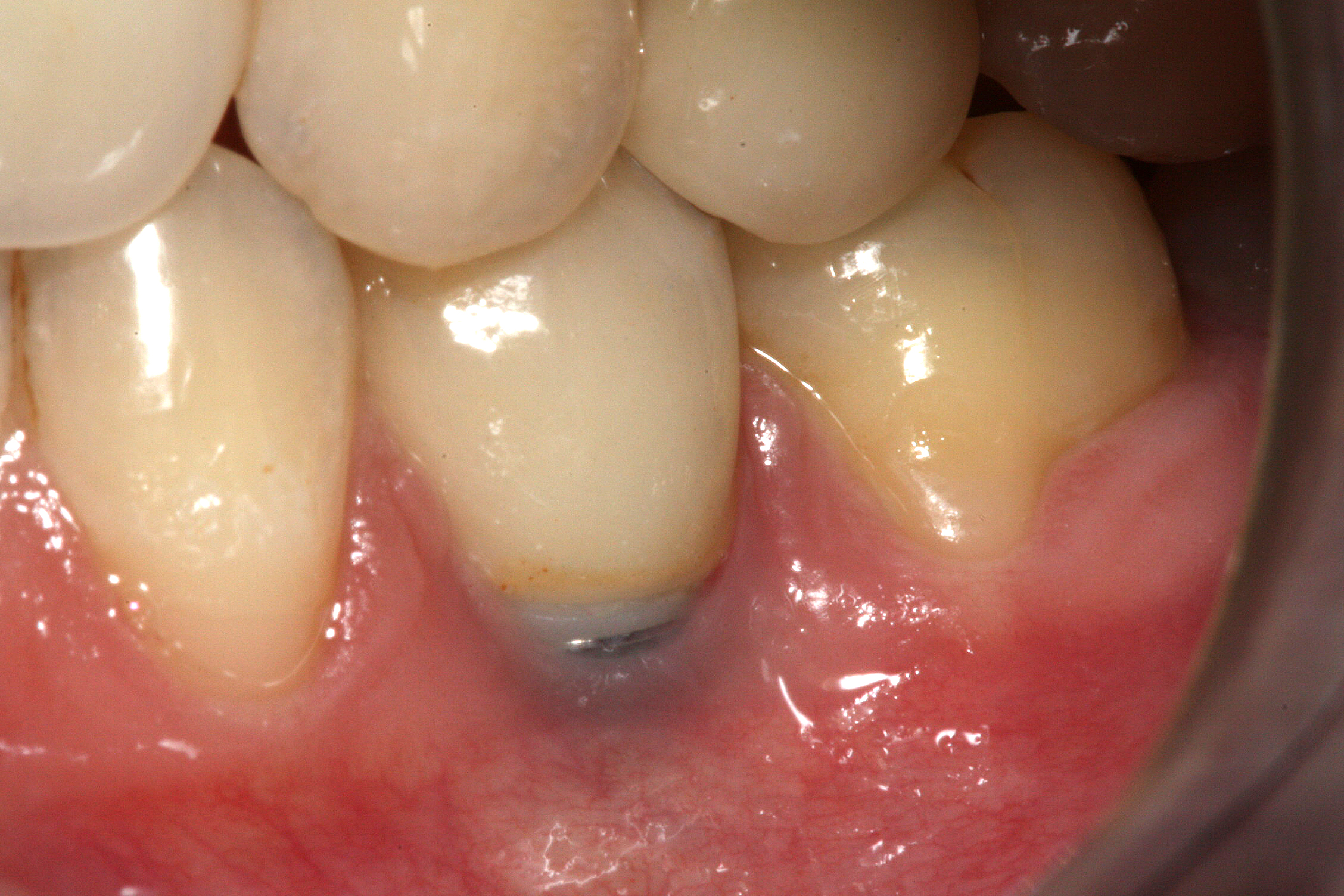 Clinical example of gingival recession

Clinical close up showing gingival recession around a dental implant, with the metal abutment visible.
