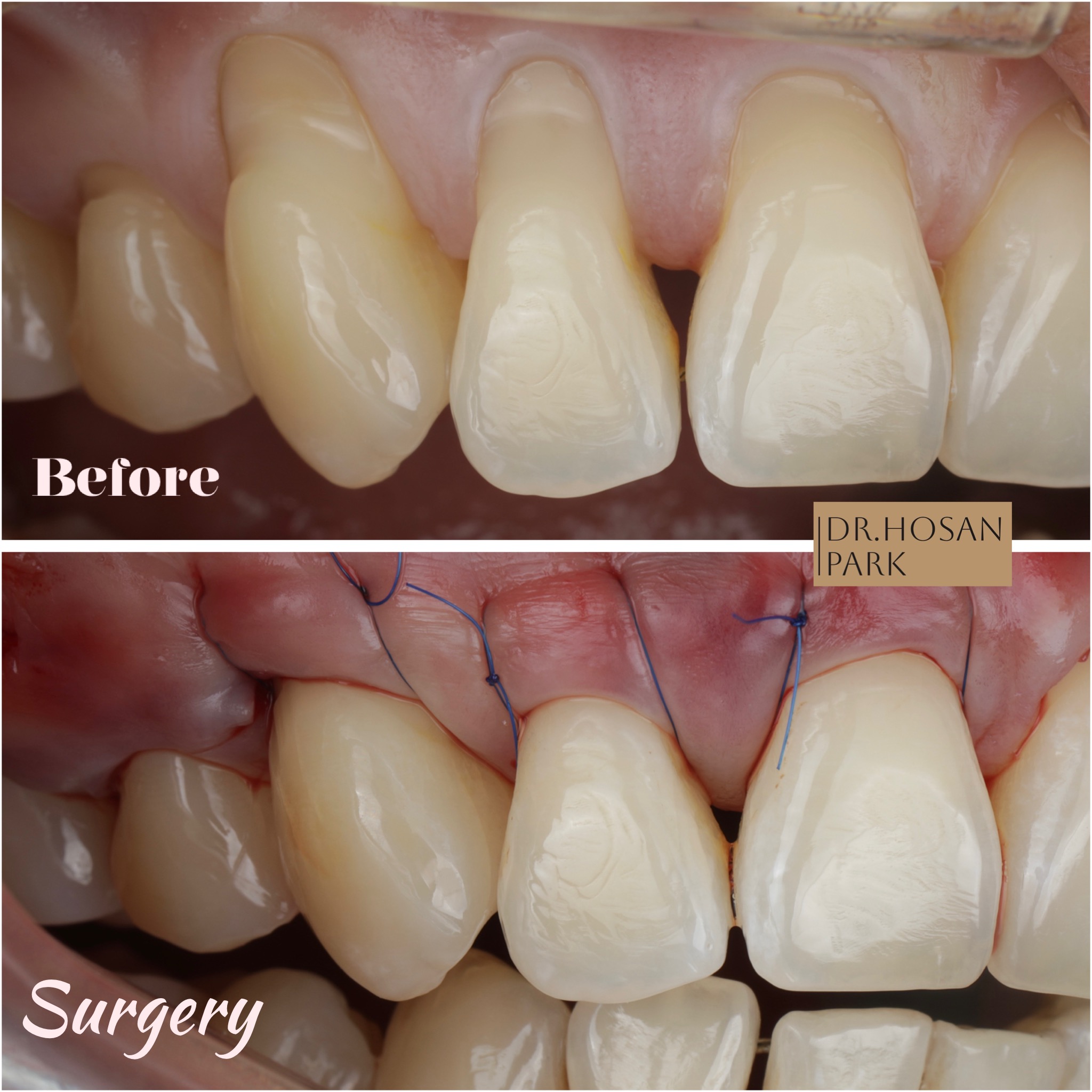 gum grafting surgery