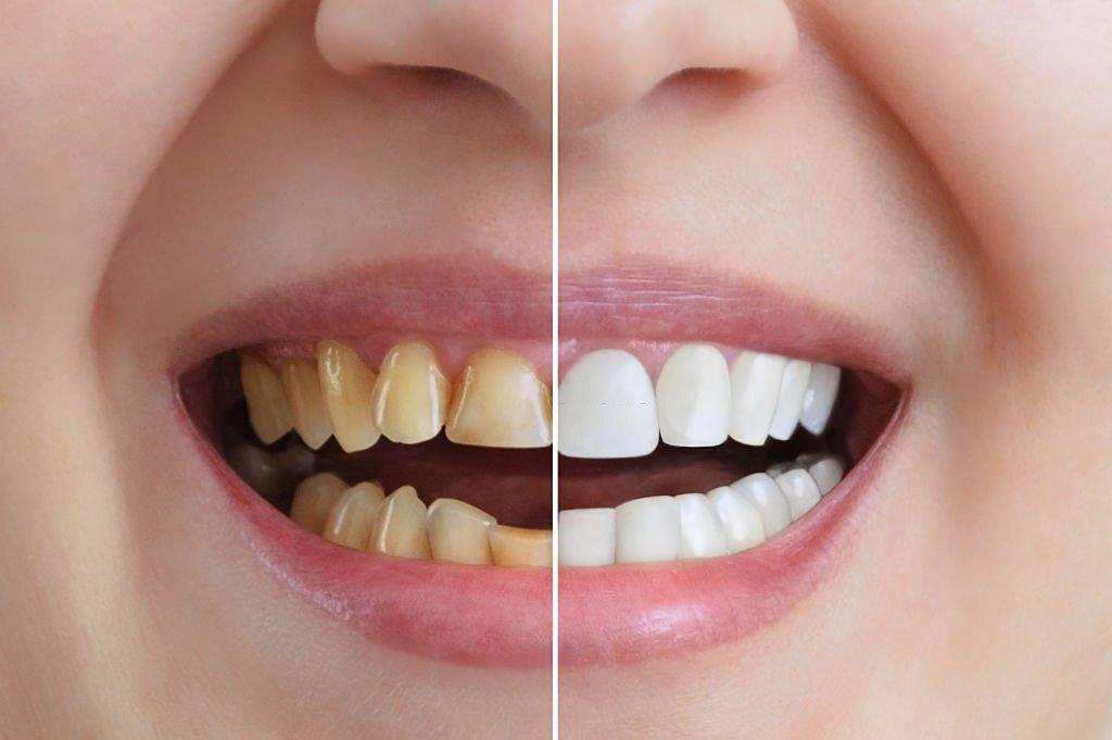 Real Life Cosmetic Dentistry Transformations