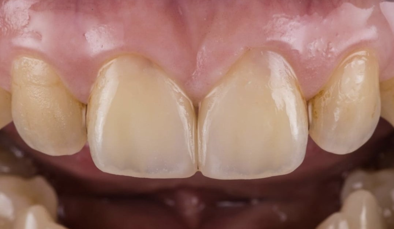 veneer cementation