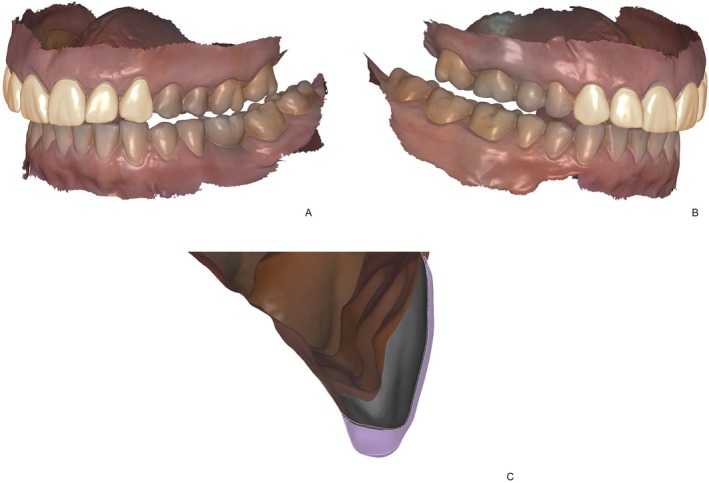 Unkovskiy et al. 2025 Figure 3 CC BY 4.0

Three part digital dental design showing right and left views of non prep veneers and a cross section of one ultra thin veneer.