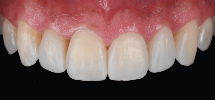 Villalobos Tinoco et al. 2022 Figure 4 CC BY 4.0

Close up intraoral photograph of a diagnostic mock up placed over the upper front teeth.